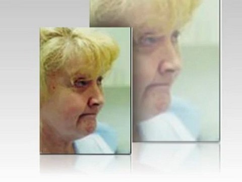 Face Lift Before and After Virginia Beach - Plastic Surgery of Virginia Beach
