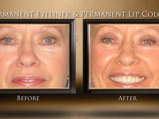 Eyelid Surgeon Phoenix, AZ – Patient Testimonial