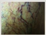 Get Rid of Spider Veins - Keeping Your Spider Veins from Getting Severe