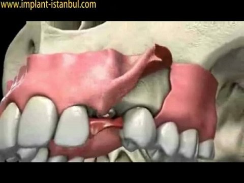 İmplant diş yapımı süreci | implant-istanbul.com