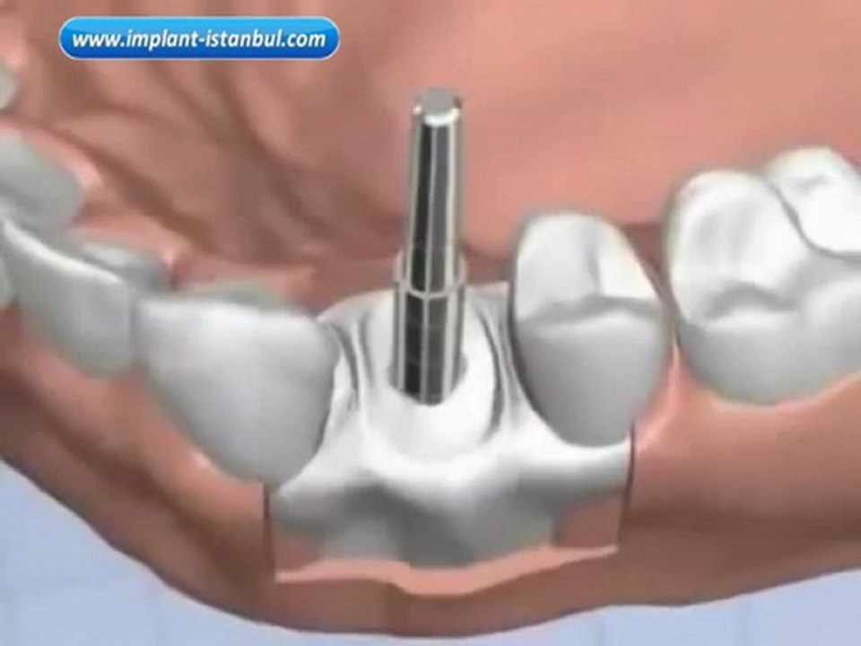 İmplant diş yerleştirilmesi animasyonu Hasta bilgilendirme videosu