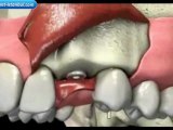 İmplant diş nasıl yapılır izle | www.implant-istanbul.com