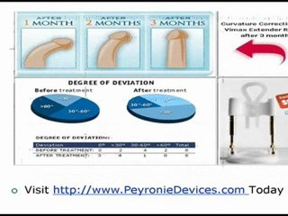 Natural Treatment in Peyronie’s Disease with External Penile Stretching