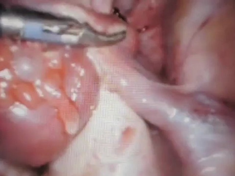 Salpinjektomi yani tüpün alınması yöntemiyle yapılan laparoskopik (kapalı ameliyat) dış (ektopik) gebelik ameliyatı