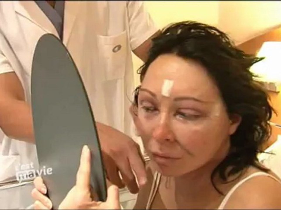 Lifting cervico-facial et lipofilling visage : résultats et cicatrices après une chirurgie esthétique du visage (Dr Montoneri)