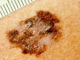 Guerra al cáncer de piel | En forma