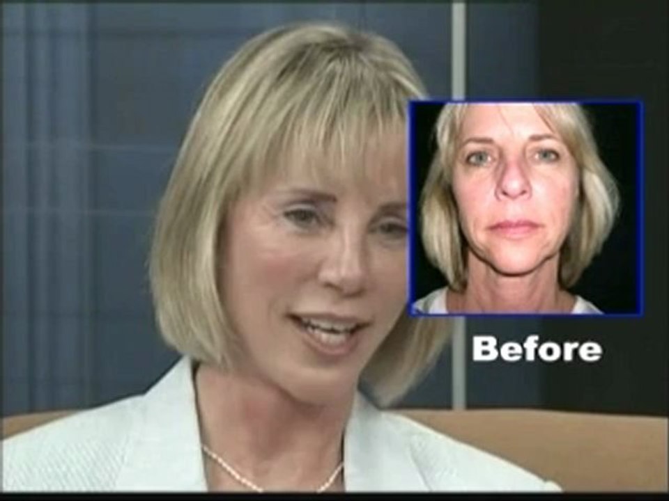 Facelift Surgery San Francisco Bay Area-A Patient Experience