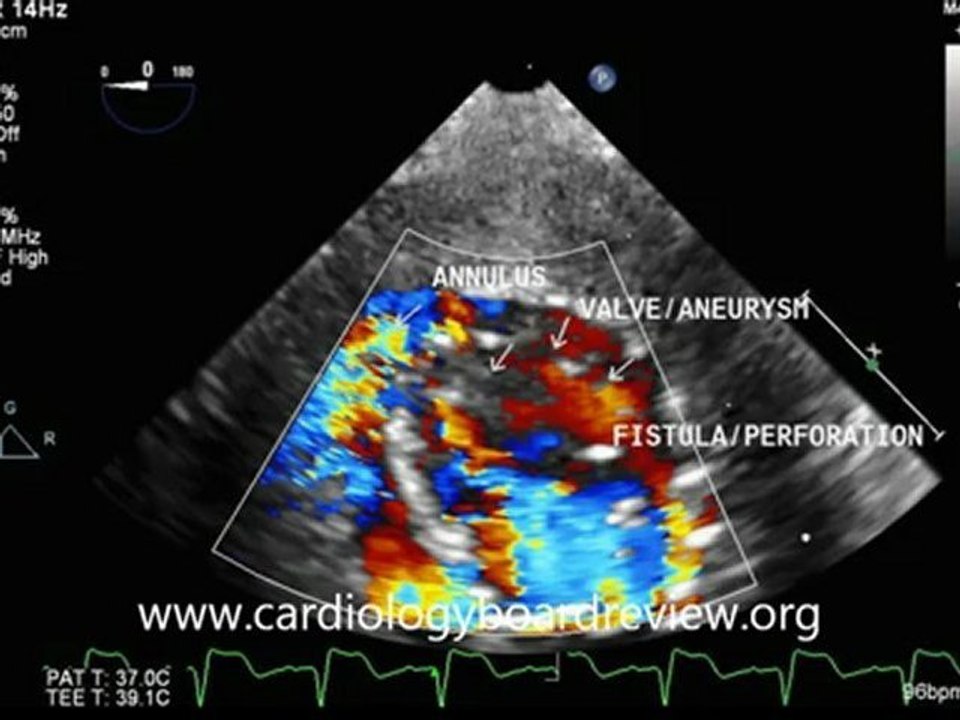 Posterior Mitral Valve Leaflet Aneurysm