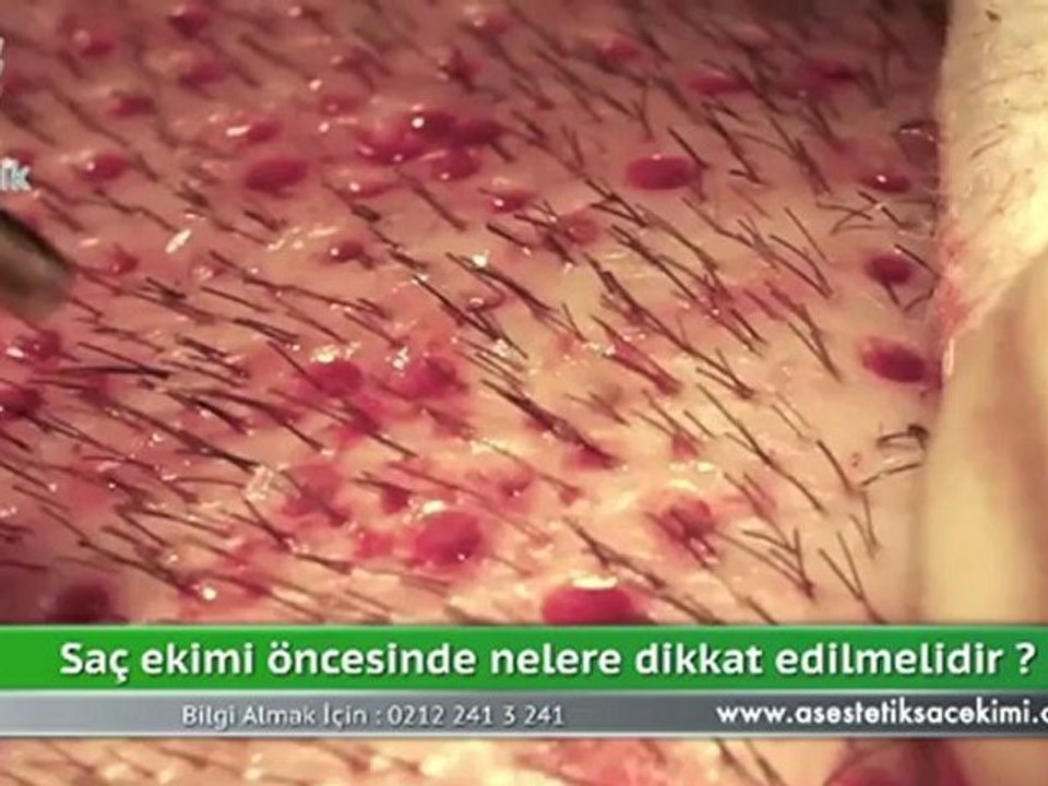 Saç Analizi ile Saç Dökülmesinin Engellenmesi & Op Dr Ali Mezdeği