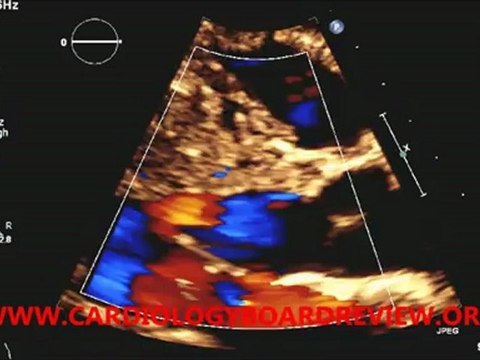 HOCM WITH Systolic anterior Motion of Mitral Leaflet