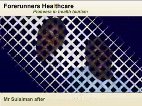 HIFU for Prostate Cancer Treatment in India – Finally a Solution to the Age-Old Problem