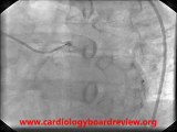 Single Coronary Artery - Single Left Coronary