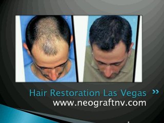 Best Hair Restoration Surgeon in Las Vegas