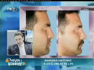 Burun Estetiği Sadece Güzellik İçin Mi Yapılır_ - TV8 Hayat Güzeldir