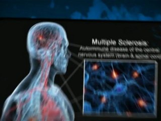 multiple sclerosis treatment