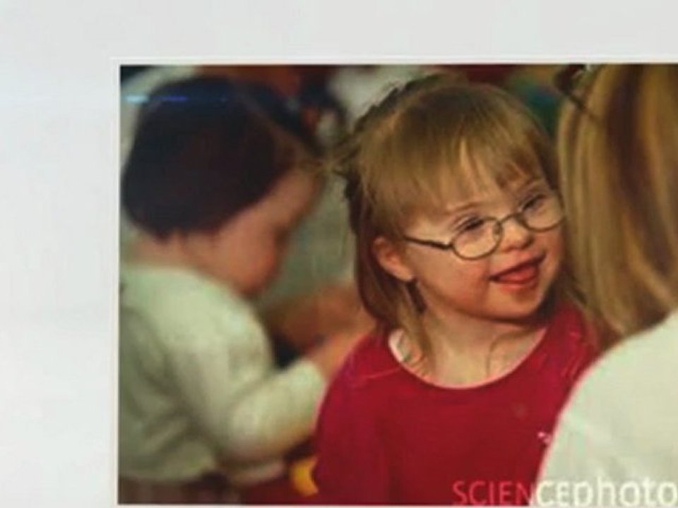 Down Syndrome Help - Down Syndrome -- Details and Its Definition