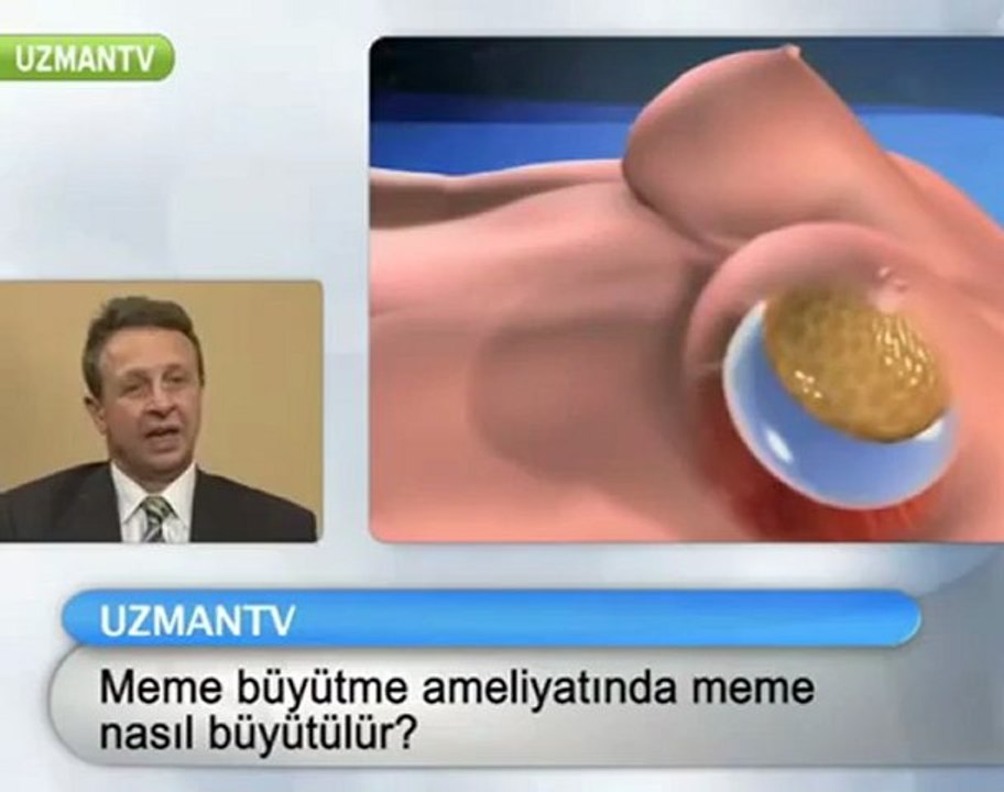 Meme Büyütme Ameliyatında Meme Nasıl Büyütülür?
