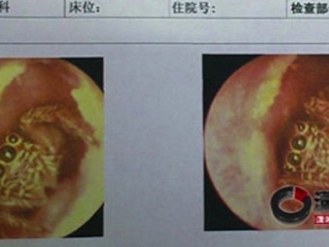 Doctor Finds Spider Inside Woman's Ear Canal