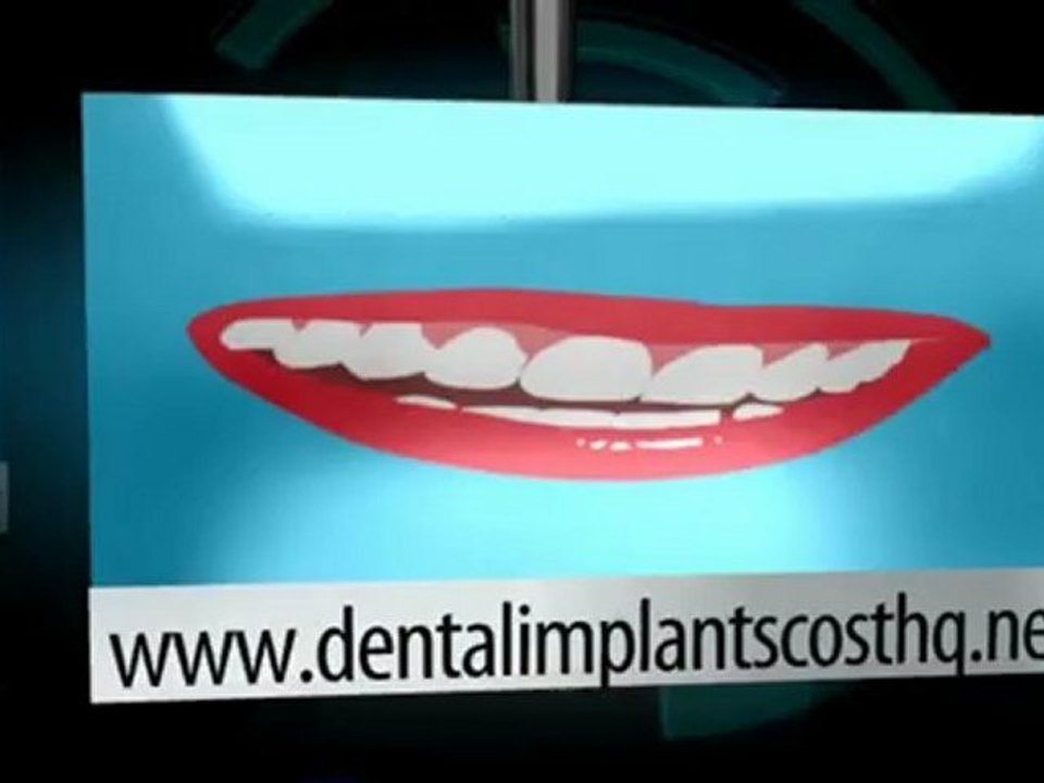 Dental Implants Cost