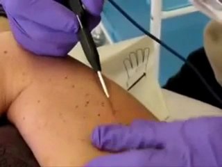 Low Cost Mole Removal