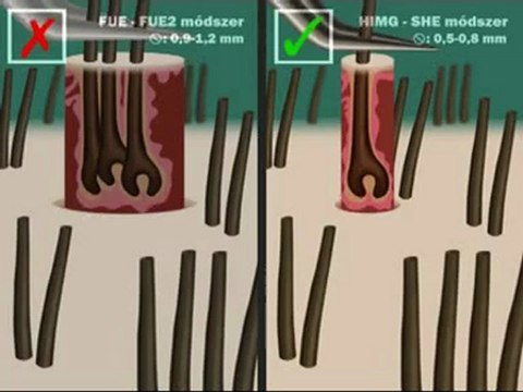 Hajbeültetés - HIMG S.H.E. Módszer 2 of 3