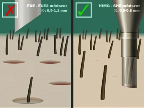 Hajbeültetés - Hajátültetés