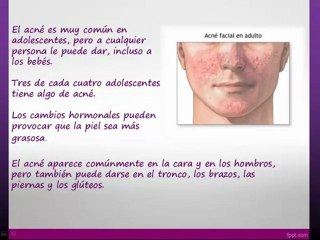 Aloe vera, rosacea y acné tratamiento natural