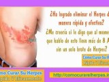 Herpes zoster sintomas - herpes tipo 2 - herpes circinado