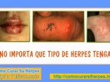 sintomas herpes - herpes soster - herpes contagio