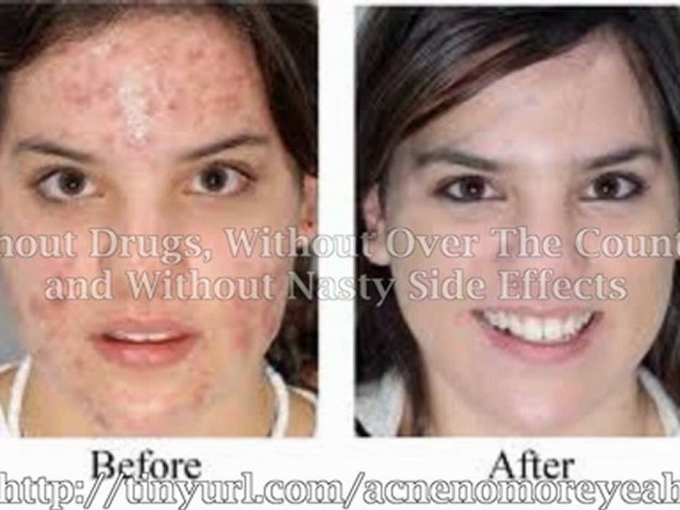 Most effective acne treatments | most effective acne treatments