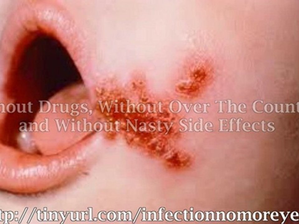 Yeast infections do it yourself treatments