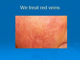 Red vein removal for Winchester and Southampton