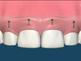 Bradenton FL Periodontist Shares Patient Education - Gummy Smile Surgery - Cosmetic Dentistry