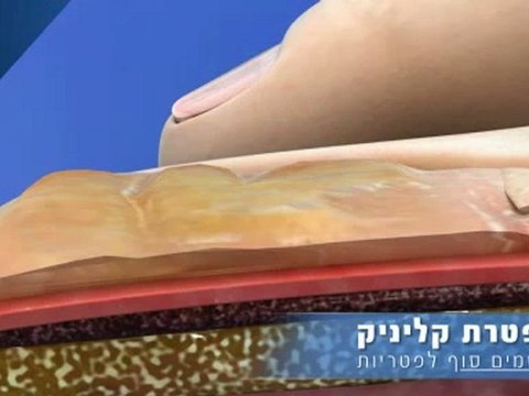 פטרת קליניק - שמים סוף לפטריות
