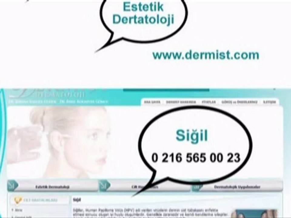 Siğil  / www.dermist.com