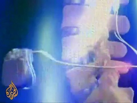 Nerve device helps paraplegic stand