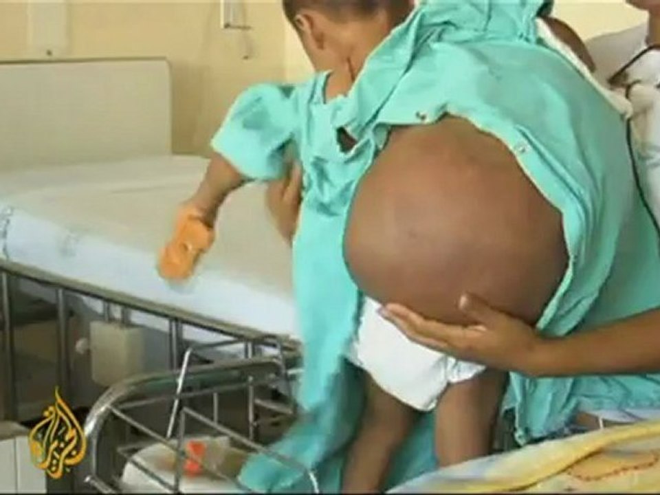 Boy has tumour half his body weight removed