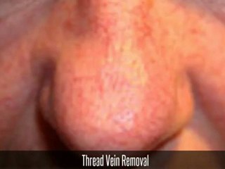Mole Vein Skin Tag Removal Winchester