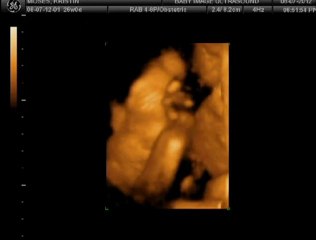 Elizabeth Grace Moses 3D Ultrasound #2
