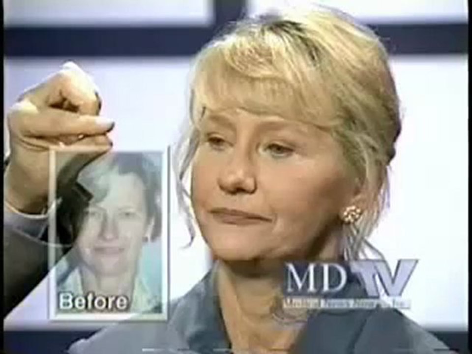 Atlanta Face Lift Surgery