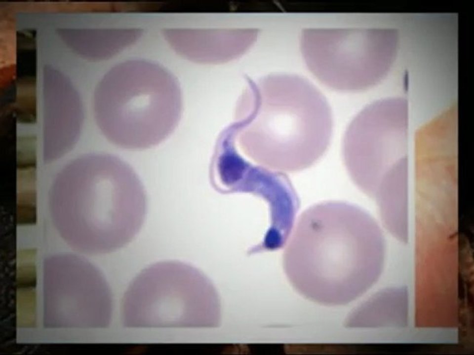 Chagas Disease - Is this New AIDS?