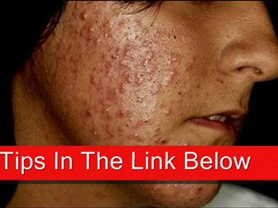 how to get rid of acne fast at home,