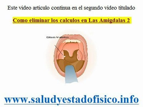 como eliminar las piedras en las amigdalas