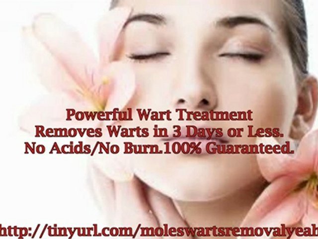 How to get rid of warts