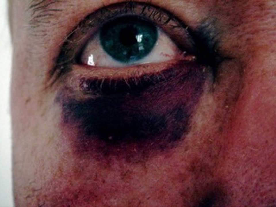 Eyes no flash