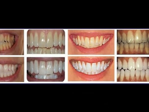 HOME TEETH WHITENING KITS
