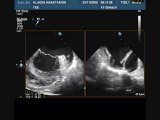 laa thrombus 2