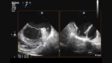 laa thrombus 2