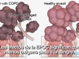 Enfermedad pulmonar obstructiva crónica EPOC