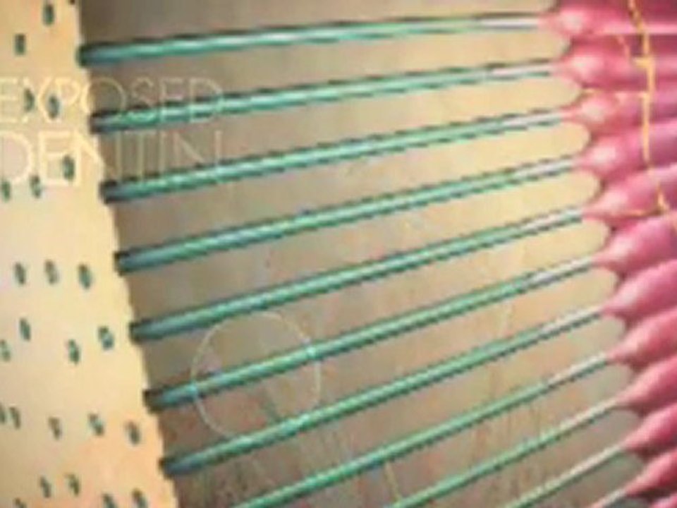 Ovde_Understanding Tooth sensitivity High